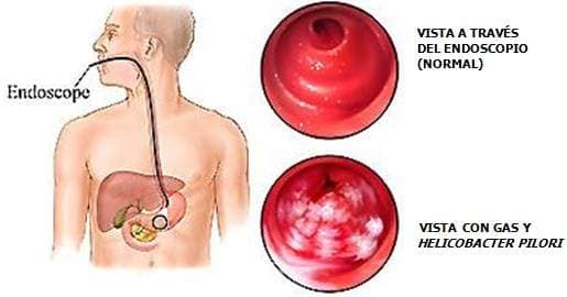 Endoscopio