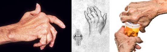artritis