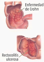 EnfermedadCrohn